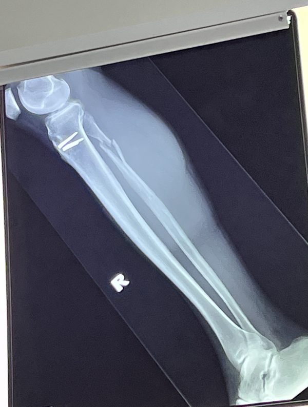 Erik Tryggestad's fractured right leg.